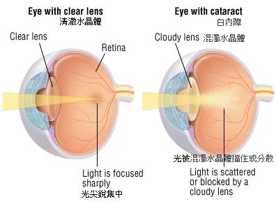 cataractform