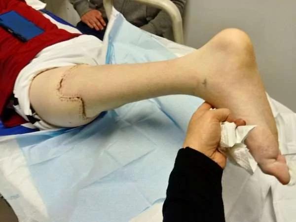 男孩的右腿被截肢 但他不靠拐杖就能快速行走 連自己都嚇到了！
