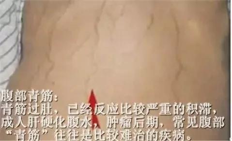 警惕!身上這部位的青筋“凸起” 當心會短命! 3 警惕!身上這部位的青筋“凸起” 當心會短命!