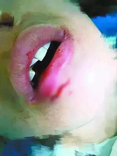 女子被宜家水杯炸斷門牙索賠百萬 這款水杯仍在售 3 女子被宜家水杯炸斷門牙索賠百萬 這款水杯仍在售