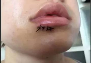 女子被宜家水杯炸斷門牙索賠百萬 這款水杯仍在售 4 女子被宜家水杯炸斷門牙索賠百萬 這款水杯仍在售