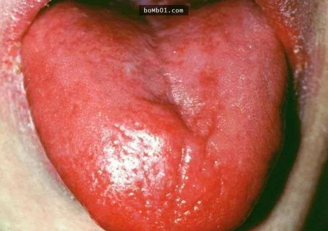 請你馬上檢查看看你的舌頭是否有出現「皺摺」 它會出現的原因一定要知道啊！