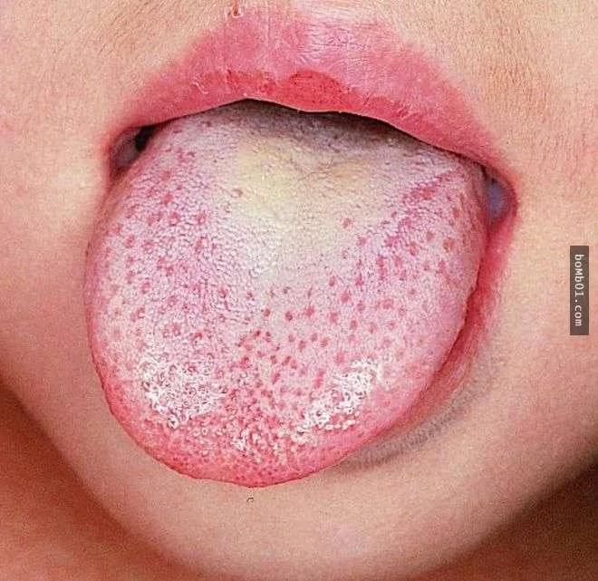 請你馬上檢查看看你的舌頭是否有出現「皺摺」 它會出現的原因一定要知道啊！