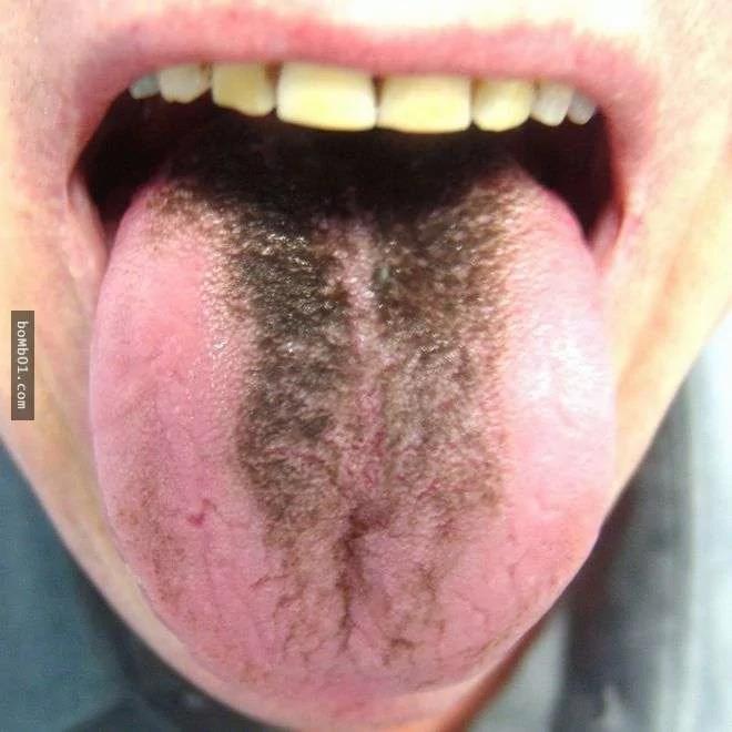 請你馬上檢查看看你的舌頭是否有出現「皺摺」 它會出現的原因一定要知道啊！