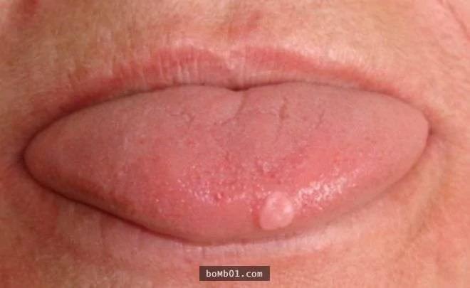 請你馬上檢查看看你的舌頭是否有出現「皺摺」 它會出現的原因一定要知道啊！
