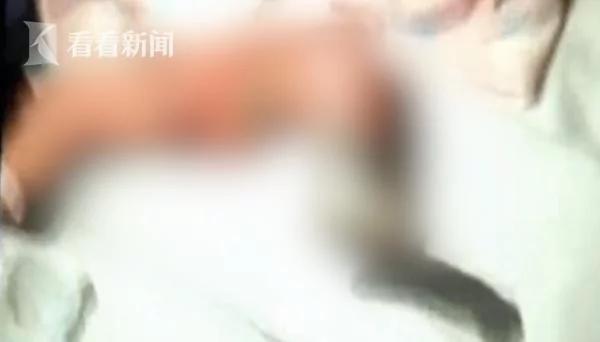 男嬰因護士忘關吹風機腿被燙傷 出生僅四天被截肢